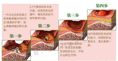 被褥疮,被褥疮用什么药好缩略图