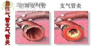 气管炎的症状(气管炎的症状和表现)缩略图