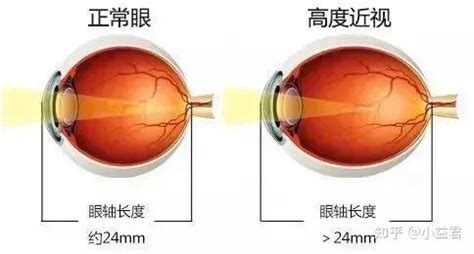 红光治疗眼睛近视有用吗(哺光仪治疗近视利弊)缩略图