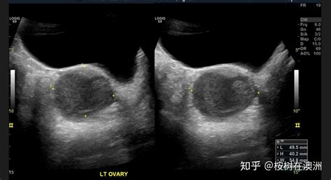 巧克力囊肿是怎么回事,巧克力囊肿是怎么回事 需要治疗吗缩略图